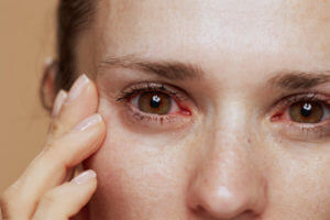 image of an women with dry eye syndrome